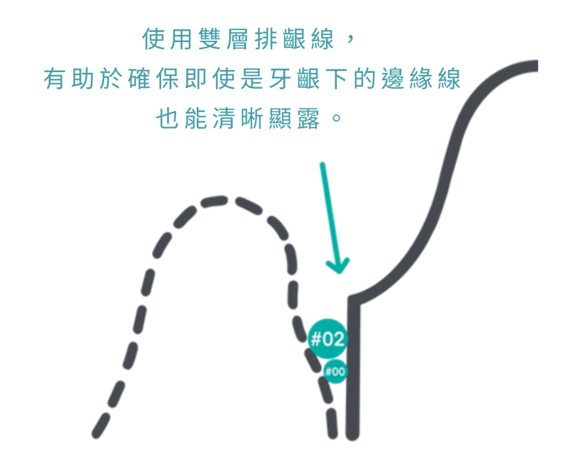 牙齦牽引不足，邊緣線不清晰