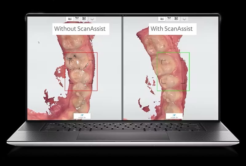 口掃機缺點，掃描出來的影像不準確，亦不能及時修改。TRIOS 5有ScanAssist AI 技術，這個功能可自動調整鏡頭，讓牙齒掃描更流暢又快速。它在掃描時能幫您輕鬆捕捉可能被忽略的部分，然後將影像無縫地拼在一起。